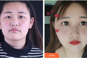 德陽(yáng)德美醫(yī)療美容門(mén)診部袁世良整形價(jià)格表附眼部綜合案例展示