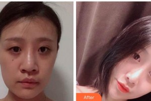 德陽(yáng)德美醫(yī)療美容門(mén)診部王亞國(guó)整形價(jià)格表附鼻部綜合案例展示