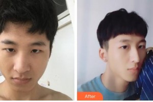 德陽(yáng)東美醫(yī)療美容整形門(mén)診部鐘正強(qiáng)整形價(jià)格表附鼻部綜合案例展示