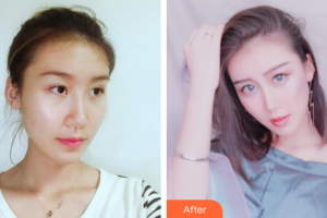 深圳瑞芙臣醫(yī)療美容門診部陳美珠整形價(jià)格表附鼻部整形案例展示