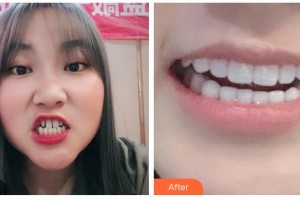 德陽(yáng)維樂(lè)新橋口腔門(mén)診部劉詩(shī)奇整形價(jià)格表附冷光美白案例展示