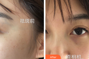 深圳臻瑞芝美醫(yī)療美容門診部張秀麗整形價(jià)格表附祛斑案例展示