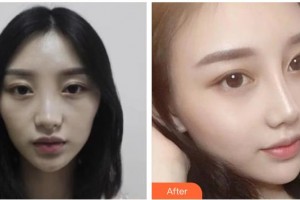 綿陽(yáng)煌佳醫(yī)學(xué)美容診所曹喜蓉整形價(jià)格表附鼻部綜合案例展示