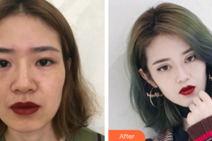 深圳臻瑞芝美醫(yī)療美容門診部周偉整形價(jià)格表附切開(kāi)雙眼皮+倒睫矯正案例展示