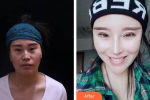 綿陽(yáng)煌佳醫(yī)學(xué)美容診所范莉整形價(jià)格表附耳軟骨復(fù)合隆鼻案例展示