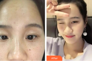 深圳新興皮膚病專科門診部方梅君整形價(jià)格表附祛雀斑案例展示