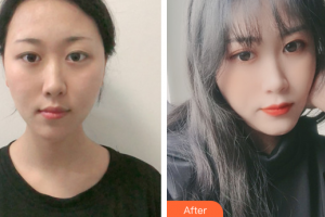 深圳星顏醫(yī)療美容醫(yī)院朱和清整形價(jià)格表附超激光美膚綜合案例展示