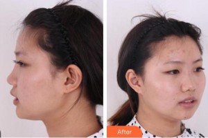 綿陽(yáng)第三人民醫(yī)院醫(yī)療美容科陳芳整形價(jià)格表附鼻部綜合案例展示