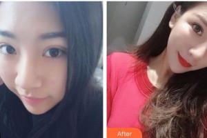 綿陽(yáng)整形美容醫(yī)院王步禮整形價(jià)格表附鼻部綜合案例展示