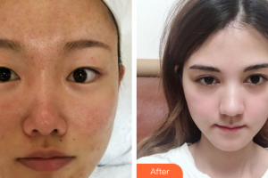 深圳多米勒醫(yī)療美容門診部周春峰整形價(jià)格表附微針嫩膚案例展示