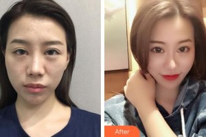 綿陽(yáng)中心醫(yī)院醫(yī)學(xué)美容科周平武整形價(jià)格表附鼻部綜合案例展示