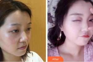 綿陽(yáng)中心醫(yī)院醫(yī)學(xué)美容科趙平武整形價(jià)格表附鼻部綜合案例展示