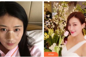 綿陽(yáng)中心醫(yī)院醫(yī)學(xué)美容科杜永忠整形價(jià)格表附鼻部綜合案例展示