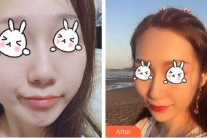 綿陽(yáng)中心醫(yī)院醫(yī)學(xué)美容科劉小意整形價(jià)格表附無(wú)針?biāo)獍咐故?>
</a>
<h3 class=