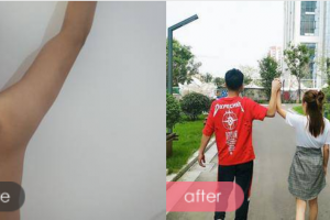 深圳腋秀腋臭醫(yī)院余漢萍整形價(jià)格表附去狐臭案例展示