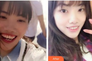 綿陽朗睿整形美容醫(yī)院梁勇生整形價格表附牙齒陶瓷矯正案例展示