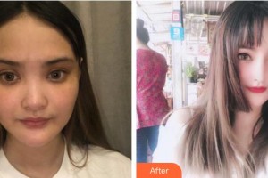 綿陽(yáng)東美奧拉克醫(yī)療美容門(mén)診部盧元?jiǎng)傉蝺r(jià)格表附耳軟骨復(fù)合隆鼻案例展示