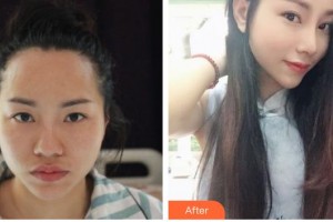 綿陽韓美醫(yī)療整形美容診所彭太平整形價格表附肋軟骨隆鼻案例展示