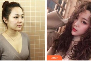 綿陽市人民醫(yī)院燒傷整形美容外科魏子人整形價格表附鼻部綜合案例展示