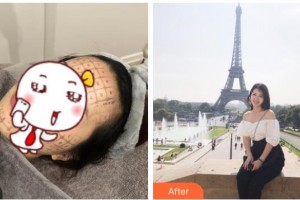 綿陽妙典整形醫(yī)院吳瑛整形價格表附熱瑪吉案例展示