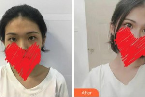 綿陽愛爾眼科醫(yī)院楊智整形價格表附切開雙眼皮案例展示