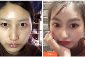 綿陽愛爾眼科醫(yī)院胥云整形價格表附切開雙眼皮案例展示