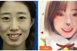 綿陽獨言口腔門診部獨言整形價格表附金屬托槽矯正案例展示