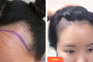 深圳華悅醫(yī)療美容門診部林宜蓉整形價(jià)格表附種植發(fā)際線案例展示