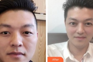 廣元美華醫(yī)學(xué)美容診所熊浩整形價格表附切開雙眼皮案例展示