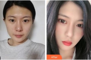 廣元美華醫(yī)學(xué)美容診所王見平整形價格表附眼部綜合案例展示