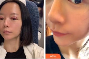 廣元市第二人民醫(yī)院醫(yī)療美容科王懷奇整形價格表附切開雙眼皮案例展示