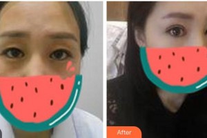 廣元美立方醫(yī)療美容醫(yī)院李民臣整形價格表附切開雙眼皮案例展示