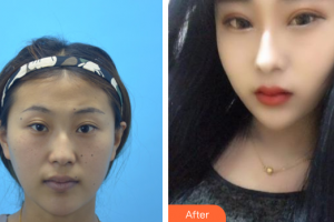 深圳潤(rùn)澤瑞尼絲醫(yī)療美容醫(yī)院胡珍珍整形價(jià)格表附切開(kāi)雙眼皮案例展示