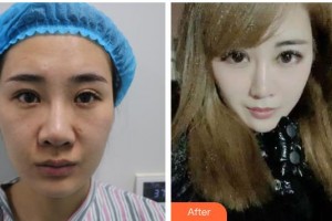 廣元市利州區(qū)第二人民醫(yī)院眼科樊樹軍整形價格表附眼部綜合案例展示