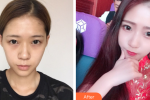 深圳黛顏醫(yī)療美容醫(yī)院李康整形價(jià)格表附眼部綜合案例展示