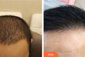 深圳黛顏醫(yī)療美容醫(yī)院李泳陀整形價(jià)格表附種植發(fā)際線案例展示