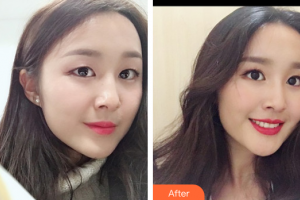 深圳美加美醫(yī)療美容門診部周國(guó)偉整形價(jià)格表附隆鼻案例展示