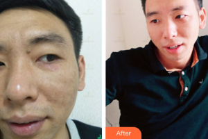 深圳美加美醫(yī)療美容門診部李莉整形價(jià)格表附激光祛斑案例展示