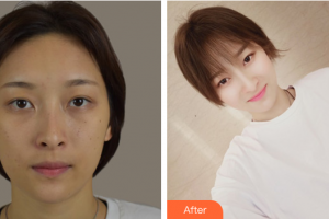 深圳建安醫(yī)療美容門診部李梓歡整形價(jià)格表附清潔祛痘案例展示