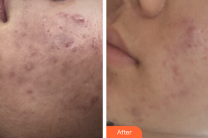 深圳建安醫(yī)療美容門診部陳史宏整形價(jià)格表附微針祛痘案例展示