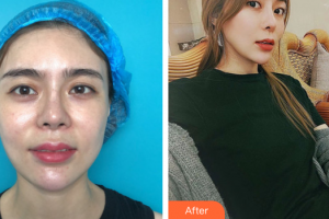 深圳建安醫(yī)療美容門診部羅君整形價(jià)格表附眼部綜合案例展示