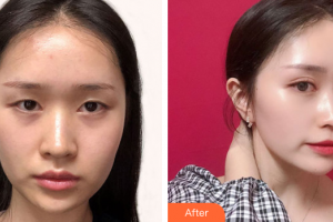 深圳香蜜麗格醫(yī)療美容門診部黎京雄整形價格表附眼部綜合案例展示