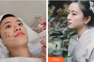 深圳星妍醫(yī)療美容診所宋月華整形價格表附熱瑪吉案例展示