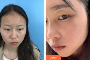 深圳星妍醫(yī)療美容診所廖祥龍整形價格表附祛痣案例展示