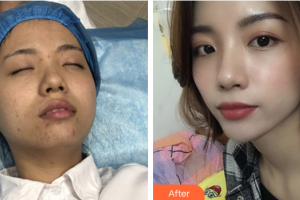 深圳悅她醫(yī)療美容診所沈洪波整形價格表附微針美塑案例展示