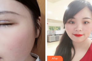 深圳詩蕾醫(yī)療美容診所劉遷整形價格表附切開雙眼皮案例展示