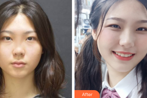 深圳陽光整形美容醫(yī)院陳星光整形價格表附鼻部多項案例展示