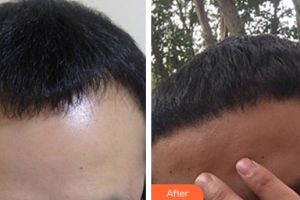 深圳陽光整形美容醫(yī)院楊浩東整形價格表附種植發(fā)際線案例展示