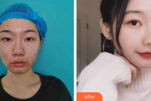 深圳美洛斯醫(yī)療美容診所張化博整形價格表附埋線雙眼皮案例展示