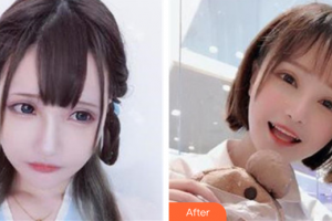 深圳麗格云發(fā)醫(yī)療美容診所劉志杰整形價格表附植發(fā)-種植發(fā)際線案例展示